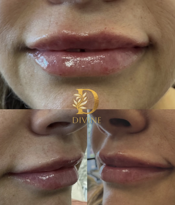 $450 Lip Filler Promotion - Now through May 15 our lip filler promotion is for $450 to new lip filler clients. Contact us today to book your appointment! $450 Lip Filler Promotion - Now through May 15 our lip filler promotion is for $450 to new lip filler clients. Contact us today to book your appointment!