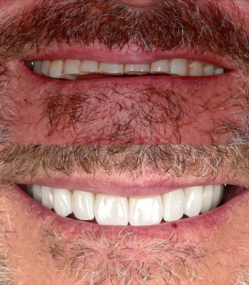 Smile Makeover - Get the beautiful smile you've always wanted. Your smile is the first thing people notice and we're here to help you achieve that smile. Smile Makeover - Get the beautiful smile you've always wanted. Your smile is the first thing people notice and we're here to help you achieve that smile.