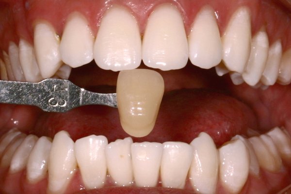 Kor Whitening cases - Various cases using the KoR whitening system - typically combines at home trays and in office treatment. Treatment time, cost, and outcome depends on severity of discoloration involved as well as patient compliance. Kor Whitening cases - Various cases using the KoR whitening system - typically combines at home trays and in office treatment. Treatment time, cost, and outcome depends on severity of discoloration involved as well as patient compliance.