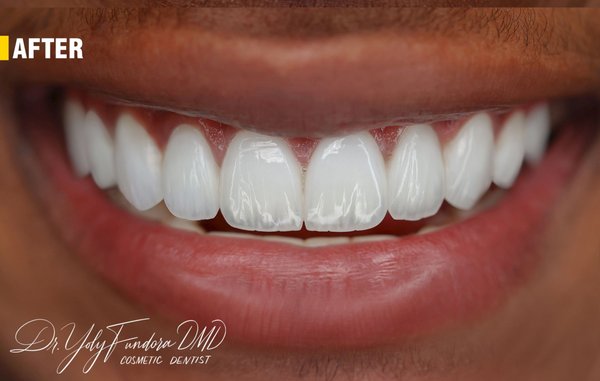 Smile Design 10 Teeth | Translucent Porcelain Veneers - Visit https://www.wholedentaldesign.com/ 20 Teeth Smile Design | Porcelain Smile Design Veneers: Finance Available with No interest up to 24mo. Get your Hollywood Smile NOW and pay letter. 20 years of experience. Affordable Dental Care. Finance Available. Enjoy this $129/Month special (50% Off Yelp Customers Deal) limited time. Boost your self-confidence with a new beautiful computerized perfect smile. Unbeatable Broward, Miami & Palm Beach Deal. Smile Design 10 Teeth | Translucent Porcelain Veneers - Visit https://www.wholedentaldesign.com/ 20 Teeth Smile Design | Porcelain Smile Design Veneers: Finance Available with No interest up to 24mo. Get your Hollywood Smile NOW and pay letter. 20 years of experience. Affordable Dental Care. Finance Available. Enjoy this $129/Month special (50% Off Yelp Customers Deal) limited time. Boost your self-confidence with a new beautiful computerized perfect smile. Unbeatable Broward, Miami & Palm Beach Deal.