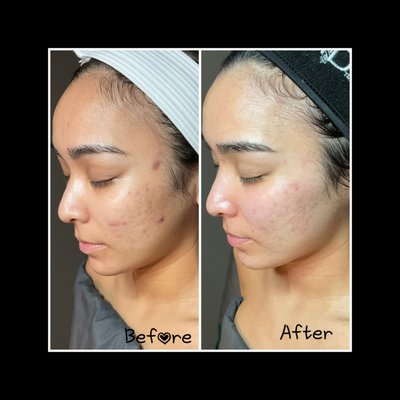 DMK Skin Revision - DMM Enzyme Treatment helps:
*Increase oxygenation, circulation, and lymphatic drainage.
*Boost cellular energy and activity
*Encourage new collagen and elastin formation
*Flush the skin to clear toxins and free radicals
Resolves Skin Condition
*Acne
*Hyperpigmentation
*Scarring
*Wrinkle and fine lines DMK Skin Revision - DMM Enzyme Treatment helps:
*Increase oxygenation, circulation, and lymphatic drainage.
*Boost cellular energy and activity
*Encourage new collagen and elastin formation
*Flush the skin to clear toxins and free radicals
Resolves Skin Condition
*Acne
*Hyperpigmentation
*Scarring
*Wrinkle and fine lines