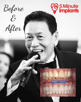 Full mouth rehab - This full mouth rehab consisted of 26 multi layered Zirconia cosmetic crowns.  The smile makeover only took 4 visits and took place within six weeks.