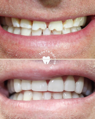 Veneers - The ultimate smile makeover treatment, veneers are custom-made from perfect porcelain for each and every tooth. This makes veneers a truly bespoke treatment, resulting in classically beautiful smile aesthetics. This is one of our most popular treatments here at Tooth Doctor LA, with patients seeking us out for our track record with this cosmetic dental treatment. Veneers - The ultimate smile makeover treatment, veneers are custom-made from perfect porcelain for each and every tooth. This makes veneers a truly bespoke treatment, resulting in classically beautiful smile aesthetics. This is one of our most popular treatments here at Tooth Doctor LA, with patients seeking us out for our track record with this cosmetic dental treatment.