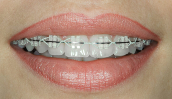 Ceramic Braces - Learn More About Ceramic Braces Ceramic Braces - Learn More About Ceramic Braces