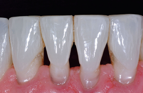 Tooth "Black Triangle" treatment with Beautiful Bioclear method - Bioclear is a revolutionary way to strengthen and beautify teeth without aggressively preparing the teeth for full crowns. Tooth "Black Triangle" treatment with Beautiful Bioclear method - Bioclear is a revolutionary way to strengthen and beautify teeth without aggressively preparing the teeth for full crowns.