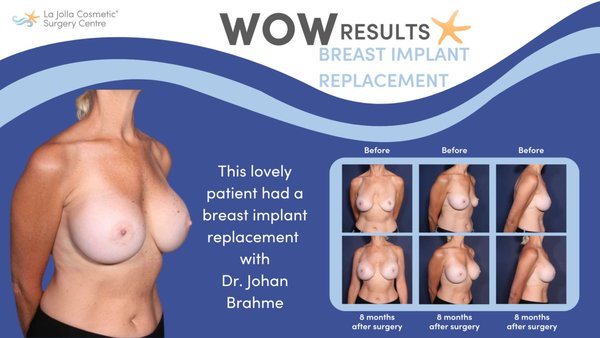 Breast Implant Replacement - If you want to keep the fullness of your implants but just need a little touch up, you can swap out your old implants for new ones. The surgeon checks the capsule, takes out the old implant, and carefully places a new one. You can opt for the same size or decide to go bigger or smaller. Here are before and after photos of breast implant replacement results by the board-certified plastic surgeons at La Jolla Cosmetic Surgery Centre in La Jolla, CA. Breast Implant Replacement - If you want to keep the fullness of your implants but just need a little touch up, you can swap out your old implants for new ones. The surgeon checks the capsule, takes out the old implant, and carefully places a new one. You can opt for the same size or decide to go bigger or smaller. Here are before and after photos of breast implant replacement results by the board-certified plastic surgeons at La Jolla Cosmetic Surgery Centre in La Jolla, CA.