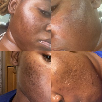 Chemical peel - One chemical peel
