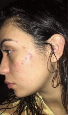 Acne - Before & After - Customized acne treatments specialized for each individual case. Acne - Before & After - Customized acne treatments specialized for each individual case.