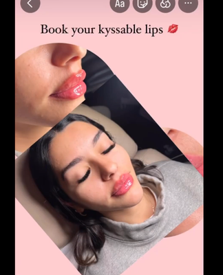 Lip Fillers - Lets Create the Lips of your Dreams together. Call us Today! Lip Fillers - Lets Create the Lips of your Dreams together. Call us Today!