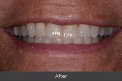 From Crowded Teeth to Confident Smiles: A Longtime Patient’s Clear Aligner Journey with Digital Scanning - For more than 15 years, this longtime patient, a wife and grandmother, has trusted Lawson Dentistry with her oral health. While she had always considered straightening her crowded teeth, the idea once felt overwhelming. In the past, orthodontic treatment required traditional impressions—messy, uncomfortable trays that often caused gagging and produced distorted results. For patients with significant crowding, impressions sometimes had to be redone multiple times, and even then, aligners could return ill-fitting, making the process frustrating and inefficient.
When she revisited treatment more recently, the experience had completely changed. Instead of relying on outdated impression methods, Lawson Dentistry used modern digital scanning technology. The process was quick, comfortable, and highly accurate, eliminating the problems she remembered. With a digital scan, she could even preview a simulation of her smile after treatment, which gave her confidence to finally move forward.
With her customized plan in place, she began clear aligner orthodontics. These nearly invisible trays gently shifted her crowded teeth into alignment without the discomfort or lifestyle limitations of traditional braces. Because the aligners were removable, she could still enjoy her favorite foods and maintain excellent daily hygiene.
Throughout treatment, she appreciated the comfort, convenience, and efficiency of each step. The aligners fit well from the start, her appointments were smooth, and she could track her progress as her smile transformed. Today, the results are clear—her teeth are straighter, her bite feels more balanced, and she can brush and floss easily without the challenges of overlapping teeth. Her smile looks brighter, stays cleaner with less buildup, and, most importantly, she feels confident and thrilled with the outcome.
Her journey is a reminder of how far orthodontic treatment has come. At Lawson Dentistry in Urbandale, digital scanning and clear aligner therapy provide a modern, precise, and comfortable solution for patients who have hesitated in the past. For anyone considering straightening crowded teeth, today’s technology makes achieving a healthier, more confident smile easier than ever. From Crowded Teeth to Confident Smiles: A Longtime Patient’s Clear Aligner Journey with Digital Scanning - For more than 15 years, this longtime patient, a wife and grandmother, has trusted Lawson Dentistry with her oral health. While she had always considered straightening her crowded teeth, the idea once felt overwhelming. In the past, orthodontic treatment required traditional impressions—messy, uncomfortable trays that often caused gagging and produced distorted results. For patients with significant crowding, impressions sometimes had to be redone multiple times, and even then, aligners could return ill-fitting, making the process frustrating and inefficient.
When she revisited treatment more recently, the experience had completely changed. Instead of relying on outdated impression methods, Lawson Dentistry used modern digital scanning technology. The process was quick, comfortable, and highly accurate, eliminating the problems she remembered. With a digital scan, she could even preview a simulation of her smile after treatment, which gave her confidence to finally move forward.
With her customized plan in place, she began clear aligner orthodontics. These nearly invisible trays gently shifted her crowded teeth into alignment without the discomfort or lifestyle limitations of traditional braces. Because the aligners were removable, she could still enjoy her favorite foods and maintain excellent daily hygiene.
Throughout treatment, she appreciated the comfort, convenience, and efficiency of each step. The aligners fit well from the start, her appointments were smooth, and she could track her progress as her smile transformed. Today, the results are clear—her teeth are straighter, her bite feels more balanced, and she can brush and floss easily without the challenges of overlapping teeth. Her smile looks brighter, stays cleaner with less buildup, and, most importantly, she feels confident and thrilled with the outcome.
Her journey is a reminder of how far orthodontic treatment has come. At Lawson Dentistry in Urbandale, digital scanning and clear aligner therapy provide a modern, precise, and comfortable solution for patients who have hesitated in the past. For anyone considering straightening crowded teeth, today’s technology makes achieving a healthier, more confident smile easier than ever.