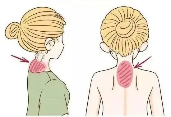 Neck and Shoulder Relief – Targeting the Cervicodorsal Fat Pa - Many people experience tension, poor posture, or fat accumulation at the base of the neck—commonly known as a “buffalo hump” or “dowager’s hump”. At Lyra Spa, our professional therapists use deep tissue and posture-corrective techniques to help reduce tension, improve circulation, and support better posture in this area.