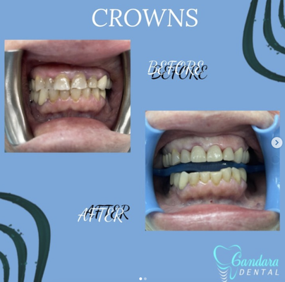 Crowns - A dental crown is a tooth-shaped "cap" that is placed over a tooth to cover the tooth to restore its shape and size, strength, and improve its appearance. When cemented into place, the crowns fully encase the entire visible portion of a tooth that lies at and above the gum line. A dental crown may be needed to protect a weak tooth from decay or breaking, to restore an already broken or severely worn down tooth, to hold a dental bridge in place, to cover misshapen or severely discolored teeth, or to make cosmetic modifications. Crowns - A dental crown is a tooth-shaped "cap" that is placed over a tooth to cover the tooth to restore its shape and size, strength, and improve its appearance. When cemented into place, the crowns fully encase the entire visible portion of a tooth that lies at and above the gum line. A dental crown may be needed to protect a weak tooth from decay or breaking, to restore an already broken or severely worn down tooth, to hold a dental bridge in place, to cover misshapen or severely discolored teeth, or to make cosmetic modifications.