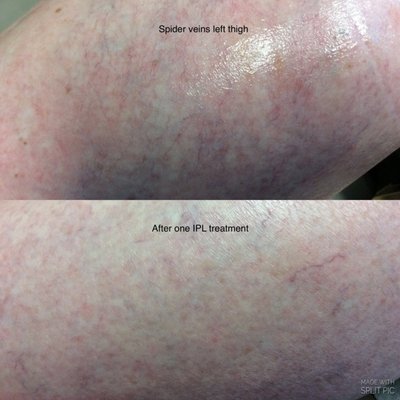 Skin Rejuvenation and body sculpting - VIVAA offers state of the art aesthetic treatments. We start with excellent skin care regimen, laser treatments- non ablative and ablative, and body sculpting with combination of coolsculpting , ultherapy and profound RF. If there are any issues with sexual dysfunction or stress urinary incontinence our female providers have great success with VIVEVE vaginal rejuvenation treatment. Finally we do have PRP for skin and hair restoration too. Skin Rejuvenation and body sculpting - VIVAA offers state of the art aesthetic treatments. We start with excellent skin care regimen, laser treatments- non ablative and ablative, and body sculpting with combination of coolsculpting , ultherapy and profound RF. If there are any issues with sexual dysfunction or stress urinary incontinence our female providers have great success with VIVEVE vaginal rejuvenation treatment. Finally we do have PRP for skin and hair restoration too.
