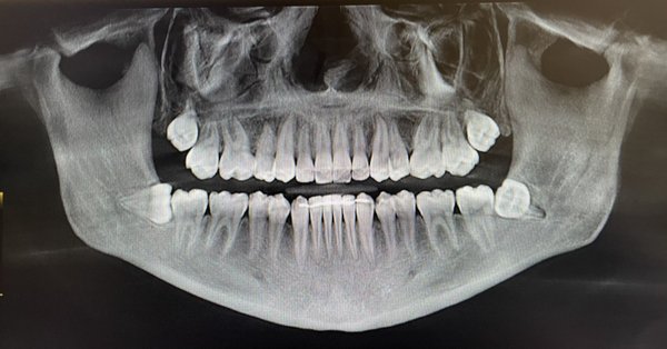 Wisdom Teeth Removal - This patient had wisdom teeth that were causing her pain. Using advanced 3-D imaging we can accurately assess the wisdom teeth and remove them with greater safety. Wisdom Teeth Removal - This patient had wisdom teeth that were causing her pain. Using advanced 3-D imaging we can accurately assess the wisdom teeth and remove them with greater safety.
