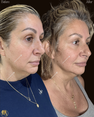Skin Tightening and Body Contouring - Skin tightening and body contouring with our density machine. Skin Tightening and Body Contouring - Skin tightening and body contouring with our density machine.