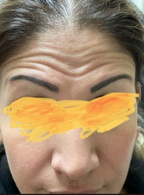 Dysport - Let me help you relax your wrinkles and restore your natural beauty. Dysport - Let me help you relax your wrinkles and restore your natural beauty.