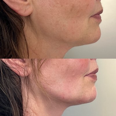 Jawline definition - Jawline definition can be quickly achieved by augmenting jawline naturally with filler like Juvederm voluma Xc or Radiesse. Jawline definition - Jawline definition can be quickly achieved by augmenting jawline naturally with filler like Juvederm voluma Xc or Radiesse.