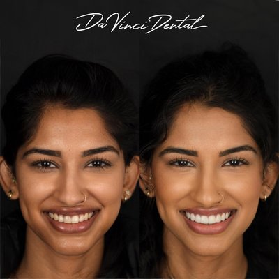 Porcelain Veneers - Previously, our patient’s teeth were distracting attention from her attractive features and it held  her from feeling her best. She disliked how her teeth weren’t white enough. Even if she tried to whiten her teeth, her front center tooth would not whiten due to it not being a natural tooth. 

The final effect that this world-class smile makeover had on her overall appearance is remarkable!