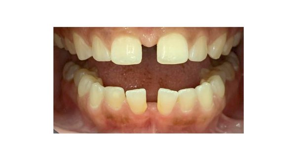 Closing up that gap! - Patient wanted to close the spaces in her teeth but she wanted her treatment plan customized to leave just a little gap between her front teeth because she was used to them :)