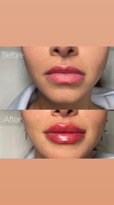 Lips Before and After - Lips before and after Photos Lips Before and After - Lips before and after Photos