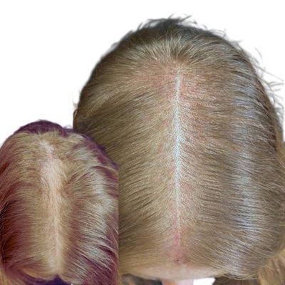 Female Hair Density Restoration - Add density to thinning areas with SMP. We reduced scalp visibility along the part for a fuller look. Non-surgical and maintenance-free. Female Hair Density Restoration - Add density to thinning areas with SMP. We reduced scalp visibility along the part for a fuller look. Non-surgical and maintenance-free.