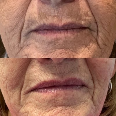 PDO Threads - PDO threads are minimally invasive polydioxanone suture threads that are placed under the skin in different areas that can help break down fat, tighten skin, build types 1 & 3 collagen and elastin, they break down over 6-8 months but your body starts building the collagen after just a few days. Some areas take multiple treatments and results are not instantaneous.
They are great for reducing lines/wrinkles, acne scars, stretchmarks, (non-keloid) scarring, neck tightening, lifting of the face, neck, breasts, butt, firming up the abdomen, arms, thighs, and helping to reduce the crepey skin around the knees and elbows. They are also incredible in the chest/decollete to smooth the skin and build collagen in the area decreasing the signs of aging. We love putting them under the eyes to reduce lines and darkening as well as around the lips in the vermillion border for nice crisp lip lines. PDO Threads - PDO threads are minimally invasive polydioxanone suture threads that are placed under the skin in different areas that can help break down fat, tighten skin, build types 1 & 3 collagen and elastin, they break down over 6-8 months but your body starts building the collagen after just a few days. Some areas take multiple treatments and results are not instantaneous.
They are great for reducing lines/wrinkles, acne scars, stretchmarks, (non-keloid) scarring, neck tightening, lifting of the face, neck, breasts, butt, firming up the abdomen, arms, thighs, and helping to reduce the crepey skin around the knees and elbows. They are also incredible in the chest/decollete to smooth the skin and build collagen in the area decreasing the signs of aging. We love putting them under the eyes to reduce lines and darkening as well as around the lips in the vermillion border for nice crisp lip lines.
