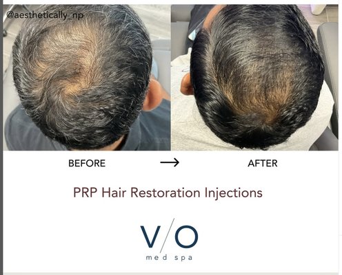 Hair Restoration - 🌟 Incredible Hair & Scalp Transformation! 🌟

Check out these amazing results after just one PRP session and one Keravive Hydrafacial! ✨ PRP stimulates natural hair growth, while Keravive deeply cleanses and nourishes the scalp for healthier, fuller-looking hair.

Want to experience the difference for yourself? Book your consultation today!