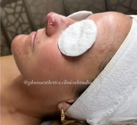 Acne grade 2 before and after results - Featuring this transformation! 🌸✨
This beautiful patient came to us with hormonal acne, facial erythema, and sensitized/irritated skin.
After a thorough consultation and skin analysis, we designed a customized clinical skincare regime and treatment plan tailored to her needs. 💎
Over the course of 8 months, we achieved these amazing results! 🌟 (Results and timelines vary depending on acne severity). Now, we’re focusing on treating her post-inflammatory hyperpigmentation for an even more radiant complexion.
Thank you for trusting us with your skin journey 💖.
Because at Glow Aesthetics, healthy & glowing skin is always in. ✨
📍 Glow Aesthetics Clinical Skincare | PMU | Lash | Brow Studio
@glowaesthetics.clinicalstudio
#temeculaclinicalesthetician #temeculawinecountry #AcneSpecialist #AcneJourney #SkinTransformation #GlowAesthetics Acne grade 2 before and after results - Featuring this transformation! 🌸✨
This beautiful patient came to us with hormonal acne, facial erythema, and sensitized/irritated skin.
After a thorough consultation and skin analysis, we designed a customized clinical skincare regime and treatment plan tailored to her needs. 💎
Over the course of 8 months, we achieved these amazing results! 🌟 (Results and timelines vary depending on acne severity). Now, we’re focusing on treating her post-inflammatory hyperpigmentation for an even more radiant complexion.
Thank you for trusting us with your skin journey 💖.
Because at Glow Aesthetics, healthy & glowing skin is always in. ✨
📍 Glow Aesthetics Clinical Skincare | PMU | Lash | Brow Studio
@glowaesthetics.clinicalstudio
#temeculaclinicalesthetician #temeculawinecountry #AcneSpecialist #AcneJourney #SkinTransformation #GlowAesthetics
