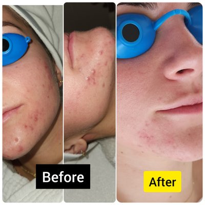 Deep Pore Cleansing - This specialty facial typically includes active ingredients that break down dead skin cells and deep pore cleanse. The facial utilizes ingredients such as glycolic and salicylic acid to unclog pores, increase cell turnover, and improve tone and texture. Deep Pore Cleansing - This specialty facial typically includes active ingredients that break down dead skin cells and deep pore cleanse. The facial utilizes ingredients such as glycolic and salicylic acid to unclog pores, increase cell turnover, and improve tone and texture.
