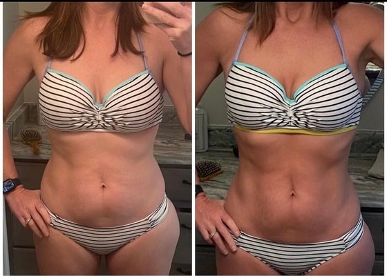 Total body transformation with Hormone Replacement/Weight Loss and Body Contouring with Coolsculpt and Emsculpt! - Are you ready to embark on a transformative journey towards a healthier, happier you? Our cutting-edge weight loss program, powered by revolutionary medications such as semaglutide (the active ingredient found in Wegovy and Ozempic), is designed to help you achieve your weight loss goals effectively and sustainably. Say goodbye to fad diets and unrealistic promises – it's time for a science-backed approach that works.
In our weight loss program we understand that obtaining medical weight loss can put patients in a vulnerable place. That’s why we take pride in creating a relaxing, professional, and comfortable environment so our clients can get the help they need to move forward with a healthier lifestyle with a customized weight loss plan. Whether you want to lose weight to look better or because you are suffering from poor health, MediMorph can help. Start your weight loss journey with a consultation today!
Testosterone Replacement Therapy is a medical intervention designed to address low levels of testosterone in the body. Testosterone, a crucial hormone for both men and women, plays a vital role in various physiological functions, including muscle development, bone density, mood regulation, and libido.
Conditions Treated With TRT:
Hypogonadism
Age-related testosterone decline
Testosterone deficiency due to medical conditions or treatments
Symptoms of Low Testosterone
Low testosterone levels can manifest in a variety of physical and emotional symptoms. Recognizing these signs is crucial for timely diagnosis and intervention.
Physical And Emotional Signs:
Fatigue and low energy levels
Reduced muscle mass and strength
Increased body fat
Mood swings and irritability
Decreased libido and sexual function
CoolSculpting® is a procedure designed to reduce fat deposits on specific parts of the body without invasive surgery. CoolSculpting® works by reducing excess fat by applying cold temperatures to the skin. It is an excellent alternative to liposuction. The goal of cryolipolysis is to freeze fat cells and eliminate them over a period of about one to three months. Several areas, including the thighs, chin, abdomen, flanks, back, buttocks, upper arms, and jawline, can be reduced by 20 to 25 percent.
As fat cells become frozen and damaged, they are naturally removed from the body through a metabolic process. CoolSculpting® treatments can provide smoother, more slender contours nearly anywhere on the body without needing prolonged postoperative recovery.
The EmSculpt Neo goes beyond muscle stimulation to reduce fat through radiofrequency and tighten skin. EmSculpt Neo is FDA cleared & scientifically proven, which takes the highly popular EmSculpt to a whole new level for improved results.
With the EmSculpt Neo, your muscles are stimulated using HIFEM technology (High-Intensity Focused Electro-Magnetic). As a result, this treatment provides stronger contractions than even professional gym equipment can provide on its own. EmSculpt Neo also uses radiofrequency to reduce fat and tighten skin. Total body transformation with Hormone Replacement/Weight Loss and Body Contouring with Coolsculpt and Emsculpt! - Are you ready to embark on a transformative journey towards a healthier, happier you? Our cutting-edge weight loss program, powered by revolutionary medications such as semaglutide (the active ingredient found in Wegovy and Ozempic), is designed to help you achieve your weight loss goals effectively and sustainably. Say goodbye to fad diets and unrealistic promises – it's time for a science-backed approach that works.
In our weight loss program we understand that obtaining medical weight loss can put patients in a vulnerable place. That’s why we take pride in creating a relaxing, professional, and comfortable environment so our clients can get the help they need to move forward with a healthier lifestyle with a customized weight loss plan. Whether you want to lose weight to look better or because you are suffering from poor health, MediMorph can help. Start your weight loss journey with a consultation today!
Testosterone Replacement Therapy is a medical intervention designed to address low levels of testosterone in the body. Testosterone, a crucial hormone for both men and women, plays a vital role in various physiological functions, including muscle development, bone density, mood regulation, and libido.
Conditions Treated With TRT:
Hypogonadism
Age-related testosterone decline
Testosterone deficiency due to medical conditions or treatments
Symptoms of Low Testosterone
Low testosterone levels can manifest in a variety of physical and emotional symptoms. Recognizing these signs is crucial for timely diagnosis and intervention.
Physical And Emotional Signs:
Fatigue and low energy levels
Reduced muscle mass and strength
Increased body fat
Mood swings and irritability
Decreased libido and sexual function
CoolSculpting® is a procedure designed to reduce fat deposits on specific parts of the body without invasive surgery. CoolSculpting® works by reducing excess fat by applying cold temperatures to the skin. It is an excellent alternative to liposuction. The goal of cryolipolysis is to freeze fat cells and eliminate them over a period of about one to three months. Several areas, including the thighs, chin, abdomen, flanks, back, buttocks, upper arms, and jawline, can be reduced by 20 to 25 percent.
As fat cells become frozen and damaged, they are naturally removed from the body through a metabolic process. CoolSculpting® treatments can provide smoother, more slender contours nearly anywhere on the body without needing prolonged postoperative recovery.
The EmSculpt Neo goes beyond muscle stimulation to reduce fat through radiofrequency and tighten skin. EmSculpt Neo is FDA cleared & scientifically proven, which takes the highly popular EmSculpt to a whole new level for improved results.
With the EmSculpt Neo, your muscles are stimulated using HIFEM technology (High-Intensity Focused Electro-Magnetic). As a result, this treatment provides stronger contractions than even professional gym equipment can provide on its own. EmSculpt Neo also uses radiofrequency to reduce fat and tighten skin.