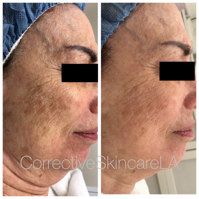 DiamondGlow - A wet microdermabrasion treatment that simultaneously exfoliates, extracts, and infuses professional-grade serums into the skin for an all-inclusive treatment
Benefits of DiamondGlow
(formerly called Dermalinfusion)
- Hydrates skin by 70% for 72 hours post-treatment
- Erases dullness and leaves the skin feeling radiant
- Visibly reduces the look of fine lines and wrinkles
- Targets specific skin concerns and optimizes results
- Promotes and stimulates healthy skin cell renewal
- Transforms skin in under 30 minutes
- Effective for the face, neck, chest, and back
- Non-invasive, no downtime
- Safe for all skin types and tones
- Patented technology DiamondGlow - A wet microdermabrasion treatment that simultaneously exfoliates, extracts, and infuses professional-grade serums into the skin for an all-inclusive treatment
Benefits of DiamondGlow
(formerly called Dermalinfusion)
- Hydrates skin by 70% for 72 hours post-treatment
- Erases dullness and leaves the skin feeling radiant
- Visibly reduces the look of fine lines and wrinkles
- Targets specific skin concerns and optimizes results
- Promotes and stimulates healthy skin cell renewal
- Transforms skin in under 30 minutes
- Effective for the face, neck, chest, and back
- Non-invasive, no downtime
- Safe for all skin types and tones
- Patented technology