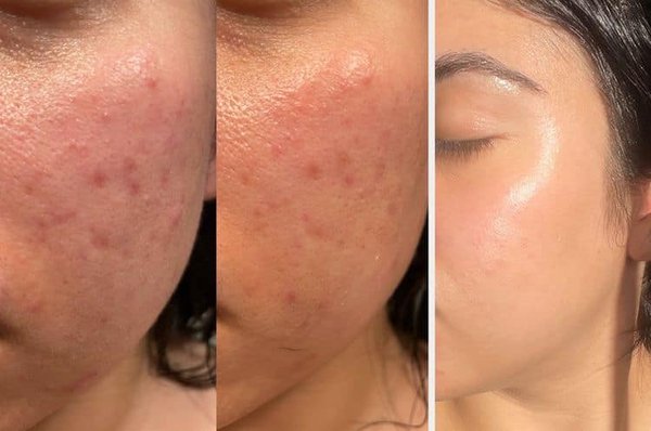 Micro-needling - Free Consultations