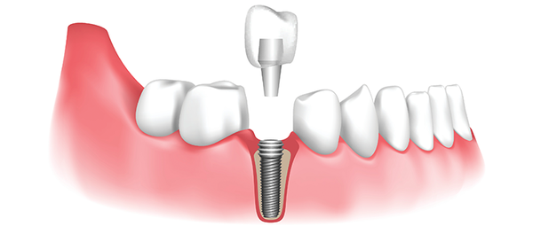Free Implant Consult - Dental implants are the ideal method for replacing missing or severely damaged teeth. As a leading dental implant Dr Felipe Galvan, surgically places implants, which grow into permanent fixtures in your mouth. He spends time ensuring that your new tooth matches the color and texture of surrounding teeth, so no one can tell which tooth is false. Schedule your dental implant consultation. Free Implant Consult - Dental implants are the ideal method for replacing missing or severely damaged teeth. As a leading dental implant Dr Felipe Galvan, surgically places implants, which grow into permanent fixtures in your mouth. He spends time ensuring that your new tooth matches the color and texture of surrounding teeth, so no one can tell which tooth is false. Schedule your dental implant consultation.