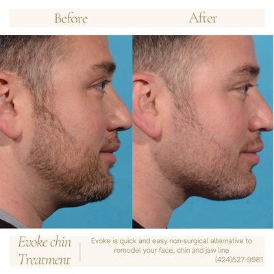 Evoke Face Contouring - Evoke is an innovative, hands-free solution that utilizes bipolar radio-frequency to effectively remodel skin and focus on facial tissue. This non-invasive option offers a convenient and efficient alternative to surgical procedures for reshaping your face, chin, and jawline.