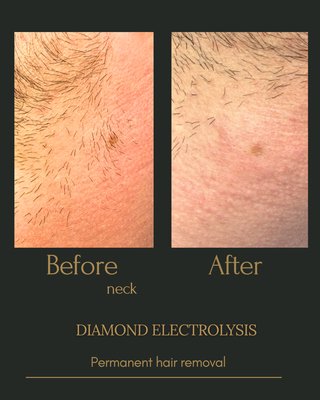 Electrolysis - Electrolysis Electrolysis - Electrolysis
