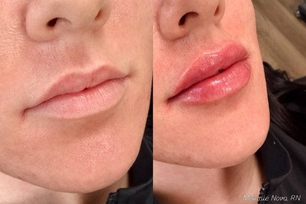 Looking for natural lip filler in Jericho, NY? - Looking for natural lip filler in Jericho, NY? At Bespoke Medesthetics, we focus on creating soft, balanced lips that enhance your features without looking overfilled.
Lip filler can add subtle volume, improve symmetry, enhance the Cupid’s bow and create smoother, more defined lips. Every treatment with Nurse Melanie is customized to your natural lip shape, facial proportions and personal goals.
Serving Jericho, Syosset, Woodbury, Plainview, Hicksville and Nassau County, Long Island. If you’re searching for subtle, natural-looking lip filler near you, Bespoke Medesthetics specializes in results designed to still look like you—just refreshed. Looking for natural lip filler in Jericho, NY? - Looking for natural lip filler in Jericho, NY? At Bespoke Medesthetics, we focus on creating soft, balanced lips that enhance your features without looking overfilled.
Lip filler can add subtle volume, improve symmetry, enhance the Cupid’s bow and create smoother, more defined lips. Every treatment with Nurse Melanie is customized to your natural lip shape, facial proportions and personal goals.
Serving Jericho, Syosset, Woodbury, Plainview, Hicksville and Nassau County, Long Island. If you’re searching for subtle, natural-looking lip filler near you, Bespoke Medesthetics specializes in results designed to still look like you—just refreshed.