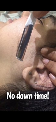 Dermaplaning - Dermaplaning is a quick and simple technique used to exfoliate the skin. We use a blade similar to a shaving blade to remove the top layers of dead skin. In the process that dreaded peach fuzz is also removed. This automatically creates the appearance of brighter, smoother skin. Dermaplaning is used to reduce the appearance of fine lines, create an even skin tone, and help reduce acne scarring. Results can be seen immediately and can last between 4-6 weeks. The procedure is painless and there is no downtime after. Dermaplaning can be combined with other services for enhanced effects. Dermaplaning - Dermaplaning is a quick and simple technique used to exfoliate the skin. We use a blade similar to a shaving blade to remove the top layers of dead skin. In the process that dreaded peach fuzz is also removed. This automatically creates the appearance of brighter, smoother skin. Dermaplaning is used to reduce the appearance of fine lines, create an even skin tone, and help reduce acne scarring. Results can be seen immediately and can last between 4-6 weeks. The procedure is painless and there is no downtime after. Dermaplaning can be combined with other services for enhanced effects.