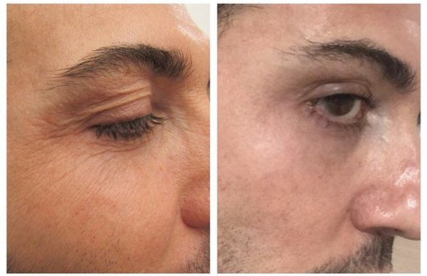 Fraxel laser skin resurfacing for eyelid wrinkles - Fraxel 1550 laser skin resurfacing for wrinkles around eyes.
Results after 3 sessions
