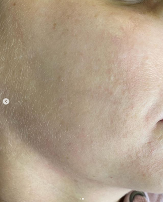 Laser Rejuvenation - Laser Skin Rejuvenation⚡️ with Lasting Results ✨ Visit us at Simply Skin for your complimentary skin assessment, and skincare regimen that's best for you. An establishment that truly cares about you