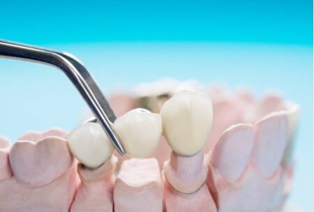 DENTAL BRIDGES - All of your teeth play an important role in speaking, chewing, and in maintaining proper alignment of other teeth. Missing teeth can and should be replaced. Dental bridges are a great way to restore your dental health and appearance with a non-invasive procedure.

There are multiple types of fixed dental bridges. Here are the three primary dental bridge options:

Traditional or conventional bridges

are the most common among dental bridge types and include a crown on each side of the appliance. One or more pontics or false teeth rest in the center of the traditional bridge, between the two crowns.

Maryland bridges

include wings made of porcelain or metal that are bonded to your teeth to fix the dental bridge into place. The false teeth of a Maryland bridge are made from porcelain, porcelain-over-metal or resin.

A cantilever bridge

only includes one crown to hold the bridge in place. This dental bridge type is used when there is only one abutment tooth available beside the missing tooth.

WHY DO I NEED A BRIDGE?

Maintenance of your facial structure:

Gaps from lost teeth can cause your face to take on a sunken appearance. A bridge fills the gaps to provide support to the soft tissues of the face.

Proper distribution of bite force:

When you chew, your teeth should share the bite force needed to masticate the food. However, when a tooth is lost, some of your teeth may take on a heavier force load. A bridge absorbs some of the bite force for a more even distribution of the pressure of your teeth.

Misalignment prevention:

Every tooth is a placeholder for the teeth that are next to it. The gap from a missing tooth can provide enough room for other nearby teeth to shift out of place. A bridge fills the gap, preventing other teeth from migrating.

Restoration of normal speech:

When you speak after losing a tooth, you may notice that it is more difficult to form your words correctly. A bridge restores the border of the teeth that is used by the tongue as you enunciate.

Decreased risk of gum disease:

Gum disease has proven to be one of the worst side effects of missing teeth and can be minimized with a bridge.

WHAT ARE THE STEPS TO GET A DENTAL BRIDGE?

1. The procedure usually takes two or three appointments to complete. At the first appointment, Dr Brazdo will prepare the teeth on either side of the space for crowns by removing a portion of the enamel.  Since the bridge must be fabricated very precisely to ensure correct bite and to match the opposing teeth, impressions of the teeth are taken and sent to a lab where the bridge will be fabricated.  You will leave the office with a temporary bridge in place.

2. Dental bridges on back teeth typically have a metal base with porcelain fused to the outside for a realistic appearance. Dental bridges on front teeth are typically made from all porcelain.  If your dental bridge is made with metal, Dr. Brazdo will try the metal portion in before the porcelain is added. This will ensure the fit is proper before the porcelain is added. If your dental bridge is made of all porcelain this step will be skipped.

3. The final step is to permanently cement the bridge.