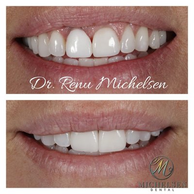 Implant Special - $1000 Implant Placement Implant Special - $1000 Implant Placement