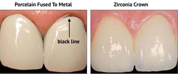 Porcelain Fused to Metal Crown(PFM) vs Zirconia Crown - A PFM crown looks somewhat dull in appearance due to a metal base which covers the remainder of the tooth. Then there are added layers of porcelain which are attached to the metal base. A PFM requires more of the healthy tooth structure to be removed in order for the crown to adhere.
Zirconia is a type of ceramic that is very hard and very durable. Zirconia crown is made from a zirconium dioxide and a stabilizer that gives it its strength. It is the hardest known ceramic in the dental industry. Due the strength of a Zirconia Crown it only requires minimal removal of tooth.
You can clearly see the difference in the photo between the PFM and Zirconia Crown. The PFM has a dark hue from the metal framework under the porcelain. The Zirconia crown feels and looks like a normal healthy tooth. Porcelain Fused to Metal Crown(PFM) vs Zirconia Crown - A PFM crown looks somewhat dull in appearance due to a metal base which covers the remainder of the tooth. Then there are added layers of porcelain which are attached to the metal base. A PFM requires more of the healthy tooth structure to be removed in order for the crown to adhere.
Zirconia is a type of ceramic that is very hard and very durable. Zirconia crown is made from a zirconium dioxide and a stabilizer that gives it its strength. It is the hardest known ceramic in the dental industry. Due the strength of a Zirconia Crown it only requires minimal removal of tooth.
You can clearly see the difference in the photo between the PFM and Zirconia Crown. The PFM has a dark hue from the metal framework under the porcelain. The Zirconia crown feels and looks like a normal healthy tooth.
