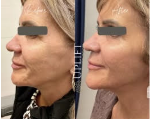MORPHEUS8 & DERMAL FILLER - Morpheus8 is a deep fractional, radio frequency treatment that delivers exceptional skin, tissue and collagen remodeling to improve skin appearance and reduce irregularities. Morpheus8 treatments result in improved jaw line, tighter neck angle, improved skin texture, and decreased number and depth of wrinkles in the face and neck. Melts adipose tissue and is indicated to treat certain areas of the body too, not just face and neck.

At no additional charge, we will topically numb the area and have a nitrous oxide and oxygen analgesia system for maximum comfort