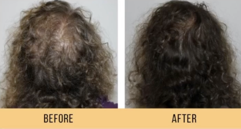 HydraScalp by Keravive - A deep cleansing and hydrating scalp treatment designed to remove buildup, improve scalp health, and support fuller, healthier-looking hair. HydraScalp by Keravive - A deep cleansing and hydrating scalp treatment designed to remove buildup, improve scalp health, and support fuller, healthier-looking hair.