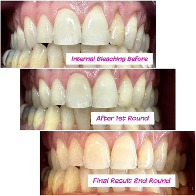 Internal bleaching - Internal bleaching. Give us a call today to book an appointment! Internal bleaching - Internal bleaching. Give us a call today to book an appointment!