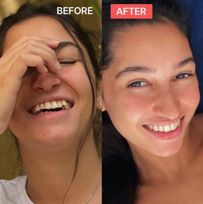 Our tech-enhanced clear aligners align mild to complex smiles. - Results to smile about. Our licensed doctors will have you smiling 2x faster with our patented Impress Lab technology. Book your free 1:1 consultation with our experienced clinical team to start your smile journey!
