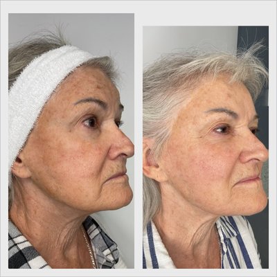 3 Sessions of RF Microneedling - After just 3 treatments of Genius RF Microneedling, this client experienced visibly smoother skin, improved texture, tone and a more lifted, refined appearance.

This advanced treatment stimulates collagen deep within the skin to reduce fine lines, improve elasticity, and restore a more youthful, radiant look—without surgery or significant downtime.