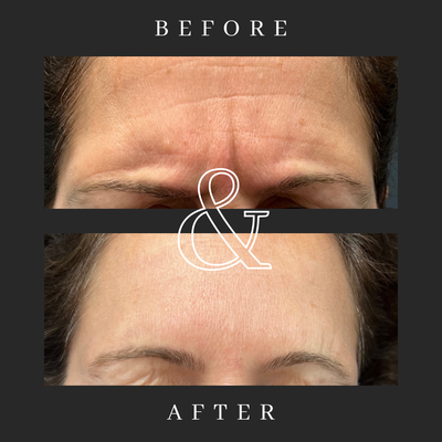 Neurotoxin Before and After - Neurotoxin use for forehead wrinkles! Results on this client were amazing!