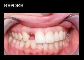 Implant Restoration - Implant placement and restoring it with solid Zirconia crown.