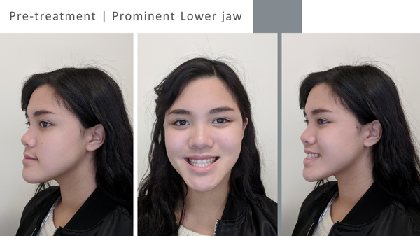 Corrective Jaw surgery - Creating a beautiful smile is an art and a science that often requires multiple experts with different specialties within the discipline of dentistry. For certain patients, orthodontics alone cannot completely address the patient’s dental and skeletal issues. If the root of the problem is the alignment of the jaw, which stems from atypical skeletal growth, surgery accompanied with braces may be the best choice to correct the bite.

Orthodontists work together with oral surgeons to ensure a successful planning of the treatment as well as the execution of the plan. As one of our patients, if we believe that you may benefit from jaw surgery, Dr. Rooz will discuss this option with you and will walk you through the details of the treatment plan.

While everyone’s situation and needs are a little different, we wanted to address some of our patients’ most frequently asked questions about corrective jaw surgery.